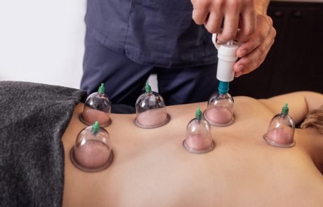 Cupping
